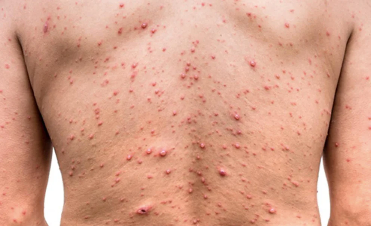 En la Argentina, el primer caso confirmado de mpox se había registrado en mayo de 2022