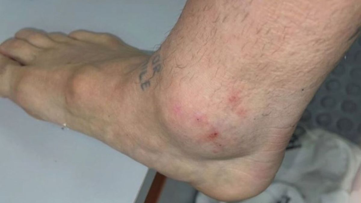 La impactante foto del tobillo del Papu Gómez tras el duelo con Chile