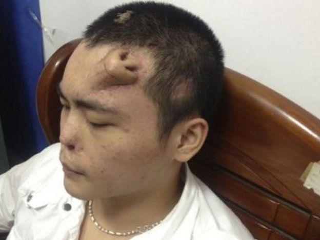 A un chino le reconstruyeron la nariz en la frente para que le crezca