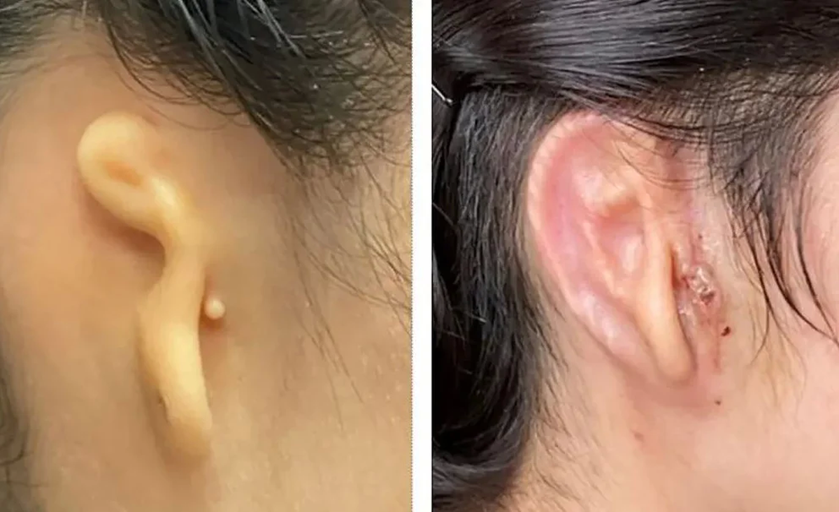 La paciente con su oreja de nacimiento y la implantada. 