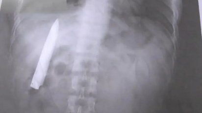 Un hombre tenía un cuchillo en el interior de su cuerpo y no lo sabía.