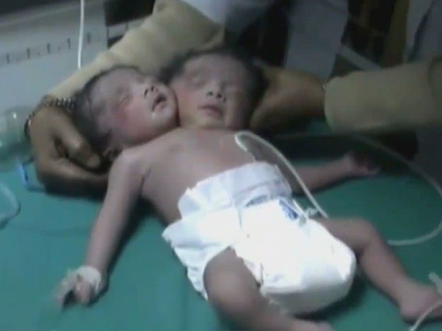 Impresionante video del bebé de dos cabezas que nació en la India