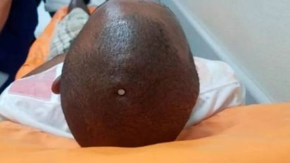 Un hombre se clavó un clavo en la cabeza porque sentía algo flojo en el cerebro.