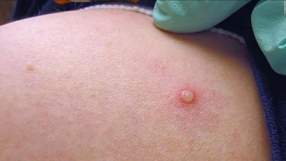 Viruela del Mono: ¿Cómo se contagia y cómo protegerse? 