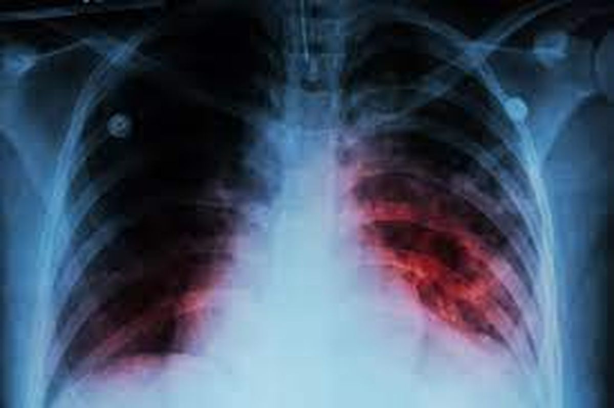 Día de la Tuberculosis: cómo ponerle fin a esta enfermedad