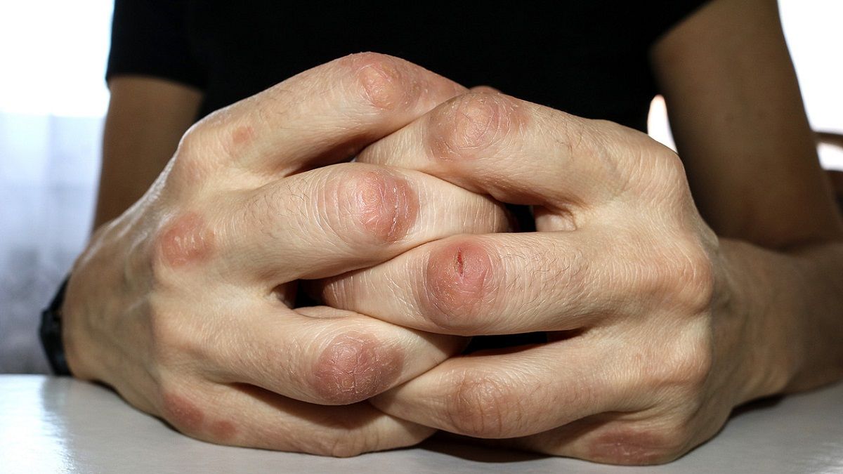 San Juan se suma a la campaña para detectar artritis psoriásica