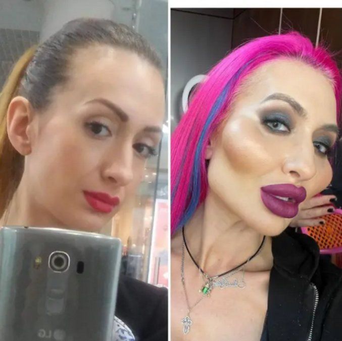 Quería tener los pómulos más grandes del mundo y se operó