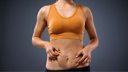 Para tener en cuenta: Cómo es la cirugía estética post parto