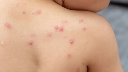 Ya son 13 los casos de viruela del mono en Argentina