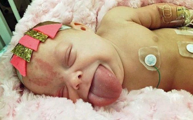 Una beba nació con lengua de adulto y desconcierta a la ciencia