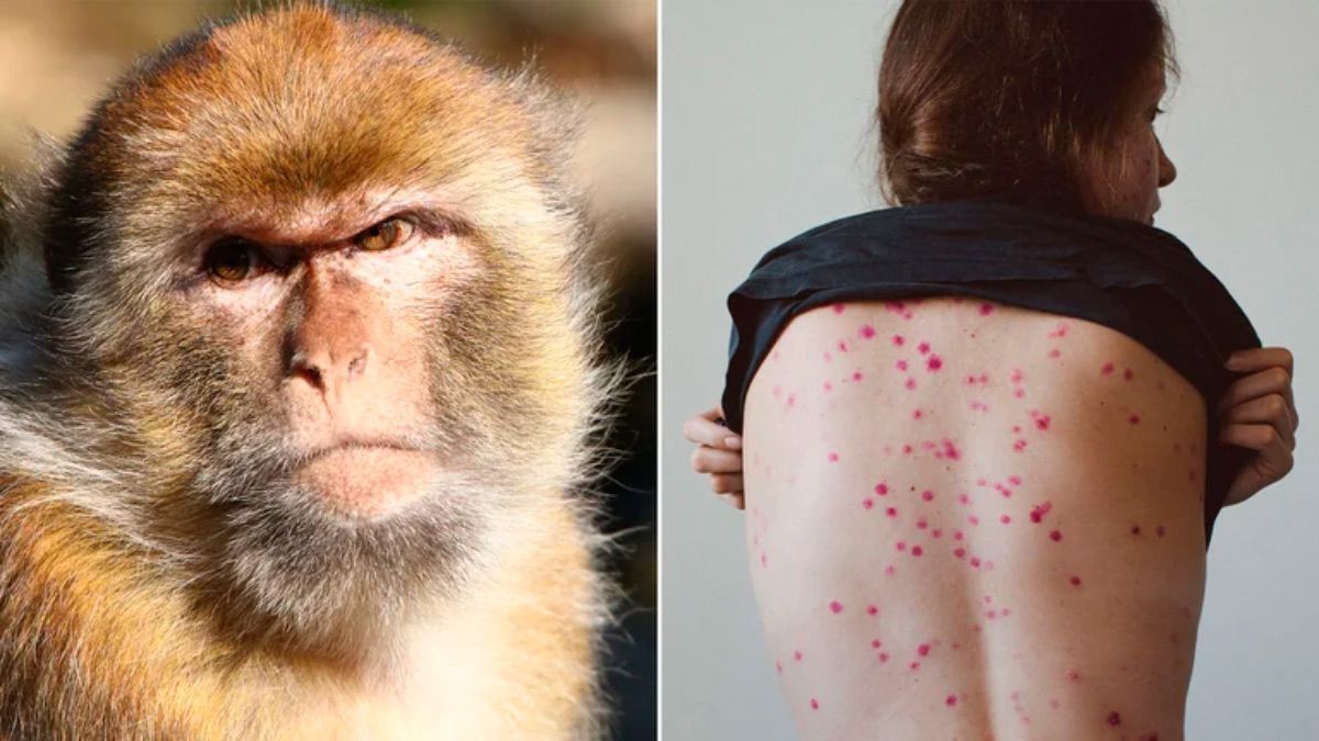 Detectaron el primer caso sospechoso de viruela del mono en la Argentina