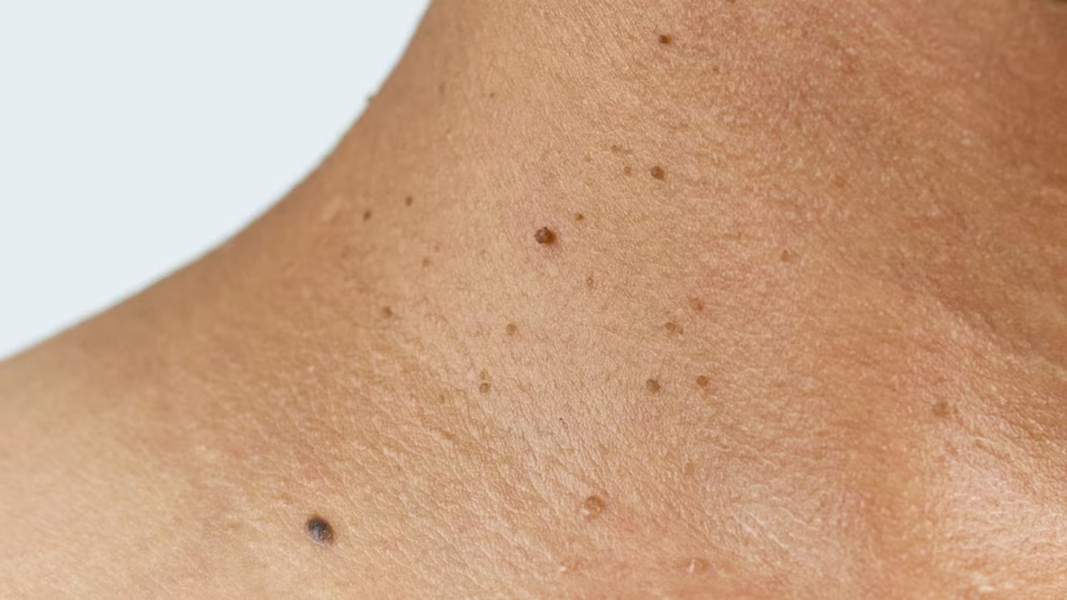 <b>Inteligencia artificial</b> mejora la detección temprana de melanoma - San Juan 8 thumbnail