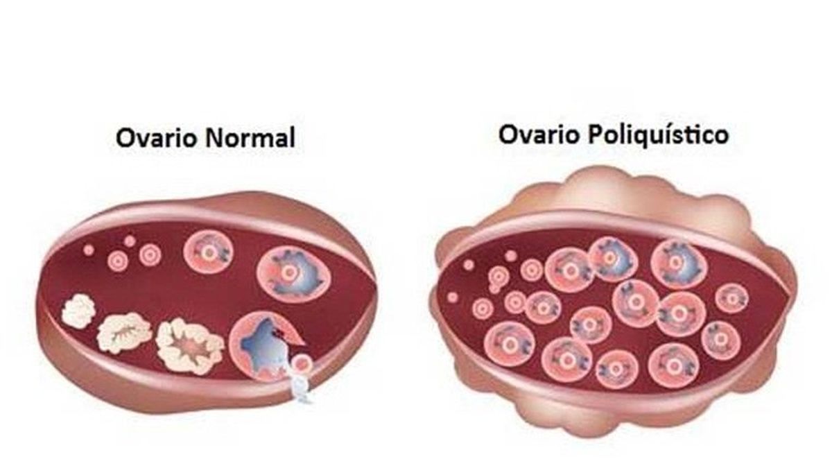 Lo Tenés Que Saber: Los Dolores De Ovarios Y Las Dietas Se Relacionan