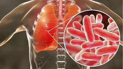 Qué es la legionella, la bacteria que causó 4 muertes en Tucumán
